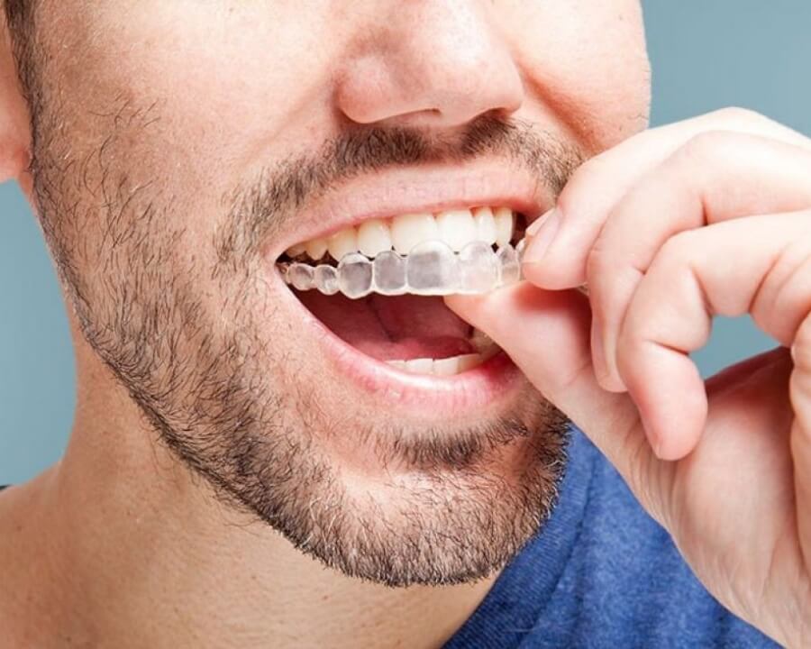 invisalign
